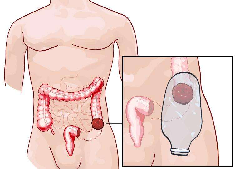 Living with a colostomy
